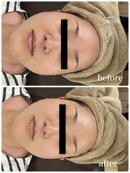 ジャスミン(Jasmin)/ダブルピール×イオン導入