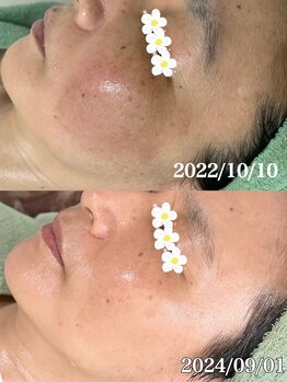 ルーチェ(LUCE)/本格ハーブピーリング