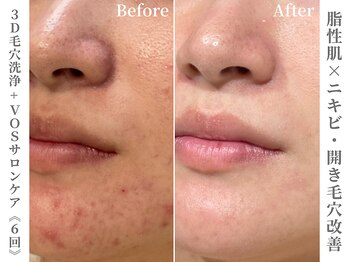 ゼアー(THERE FY.)/月に一度の肌管理