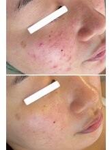 美時雨/ニキビにお悩みの方！