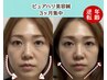 10日間限定3名【写真映り120%】自信を持って笑える小顔に導く!集中美容鍼