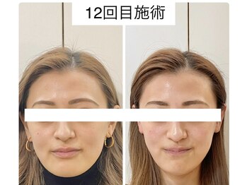 ウニカ(Unica)/BeforeAfter
