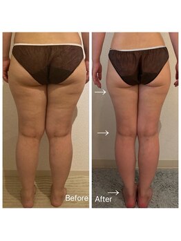 アティレ オオサカ(Attirer Osaka)/肥大化した太もも＆ふくらはぎ