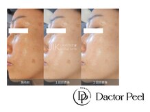 ココロミ(cocoromi)の雰囲気（ララピール進化版！話題の第5世代ピーリング「ダクトピール」）