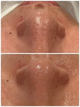 ビオエル 福岡(BIOEL)/毛穴の開き、くすみケア