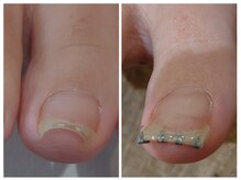 アンティ(Aunty)/巻き爪補正