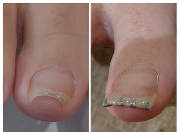 アンティ(Aunty)/巻き爪補正