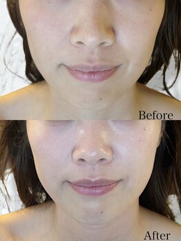 ルミライ(Lumirai)/たるみ改善|毛穴|フェイシャル