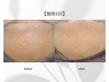 アン ビューティー(ann beauty)/施術1回【症例写真】