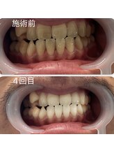 スマイルホワイト/50代男性