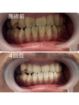 スマイルホワイト/50代男性