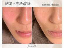 スリースリー 恵比寿(THREE THREE)/乾燥・赤みケア