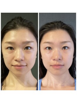 キラリ(Kirari)/【美肌エステ1回の施術】