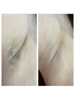 サロンアンドスクール ローズマリー (Salon&School Rosemary)/脇のワックス＆光照射併用