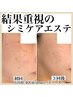 【シミ当て放題＋美白原液導入＋マッサージ】シミケアコース￥13000→￥9000
