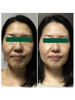 ヴィーナス 三ツ境店(VENUS)/ハーブピーリング