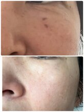 ルーメ(lume)/シミケア50代女性