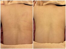 シェービングアンドエステ ブランピュア(Blanc pur)/背中美人シェービング