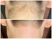 トリディア/えりあし脱毛