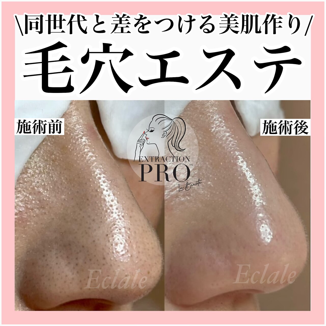 毛穴エステ 込900円 エクラーレ(Eclale)｜ホットペッパービューティー