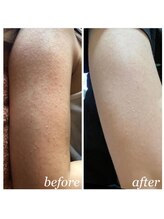 オアジスパ(Oasi Spa)/二の腕ブツブツ・サメ肌改善