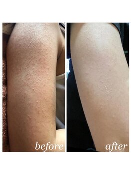 オアジスパ(Oasi Spa)/二の腕ブツブツ・サメ肌改善