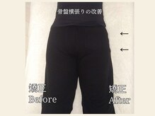 ミレア(Milea)/骨盤矯正で横張り改善