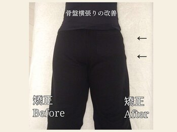 ミレア(Milea)/骨盤矯正で横張り改善