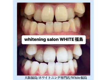 ホワイトニングサロン ホワイト(WHITE)/セルフホワイトニング/大阪/福島