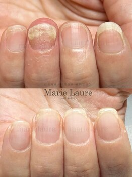 マリーロール 梅田店(Marie Laure)/自爪育成/深爪矯正/ネイルケア