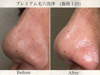 フラリ 西葛西(Hulali)/【30代】男性フェイシャル毛穴