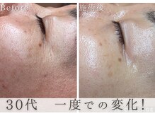 アルム(Areum)/目尻の小じわ・毛穴縮小☆