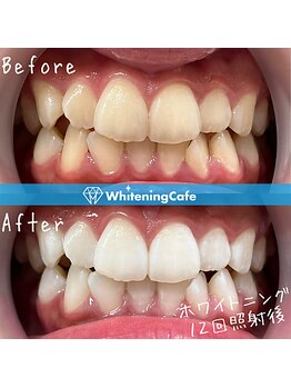 ホワイトニングカフェ 池袋東口店/ホワイトニングビフォーアフター