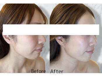ルミライ(Lumirai)/たるみ改善|毛穴|フェイシャル