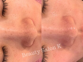 ケイ(K)/防府エステ★毛穴改善集中コース