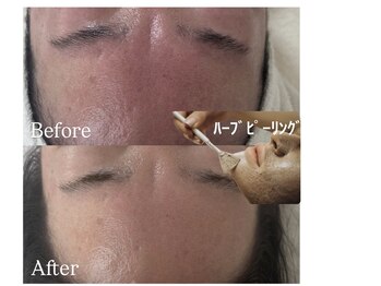 ナチュリー(Naturry)の写真/3日後、別人級のお肌になれる。エステ以上の結果が出ると話題のハーブピーリング!