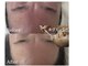 ナチュリー(Naturry)の写真/3日後、別人級のお肌になれる。エステ以上の結果が出ると話題のハーブピーリング!