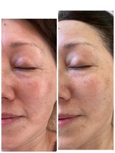 キラリ(Kirari)/【美肌エステ１回の施術】