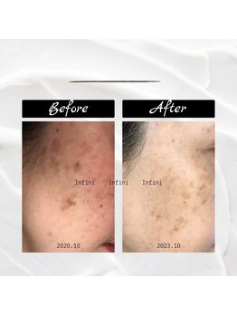 アンフィニ 麻布十番(Infini)/ハーブピーリング/NPVA