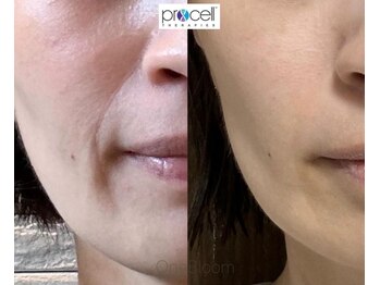 ワンブルーム(OneBloom)/ほうれい線/マリオットライン