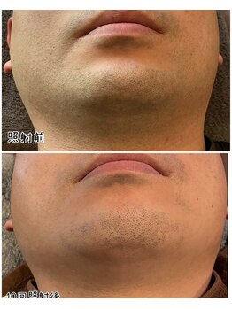 メンズサロン エイチ(H)/しぶとい髭脱毛