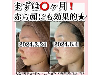 アルムダアクア 天王寺店(Aleumda AQUA)/ハーブピーリング/大阪/天王寺