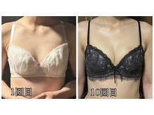 リルマコ/バスト症例写真