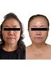 【人気No.１】Vライン復活★看護師施術でたるみ引き上げ＆しわ・小顔造形ケア
