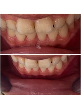 エクシアホワイトニング 代々木店/ホワイトニングビフォーアフター