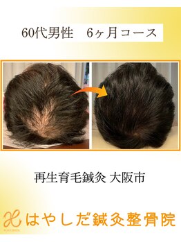 はやしだ鍼灸整骨院/育毛促進鍼灸で見た目に自信を！