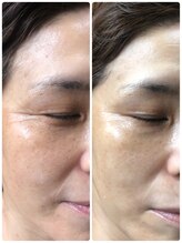 キラリ(Kirari)/【美肌エステ２回/月3ヶ月継続】