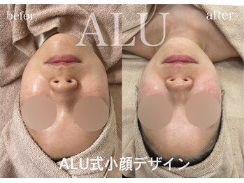 アルフォービューティ 難波店(ALU for beauty)/施術