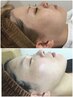 【人気♪小顔リフト】二重アゴ&フェイスラインを撲滅！最強小顔リフト9900円