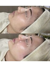 ミーミドットアイ(Mi-mi.i)/艶肌フェイシャルワックス脱毛